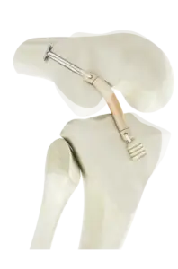 Bouton Cage DT4 vue rapprochée du mécanisme - Ortho Cape