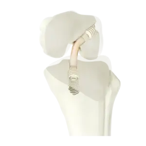 Détail de la double boucle Cage Cage DT4 - Ortho Cape